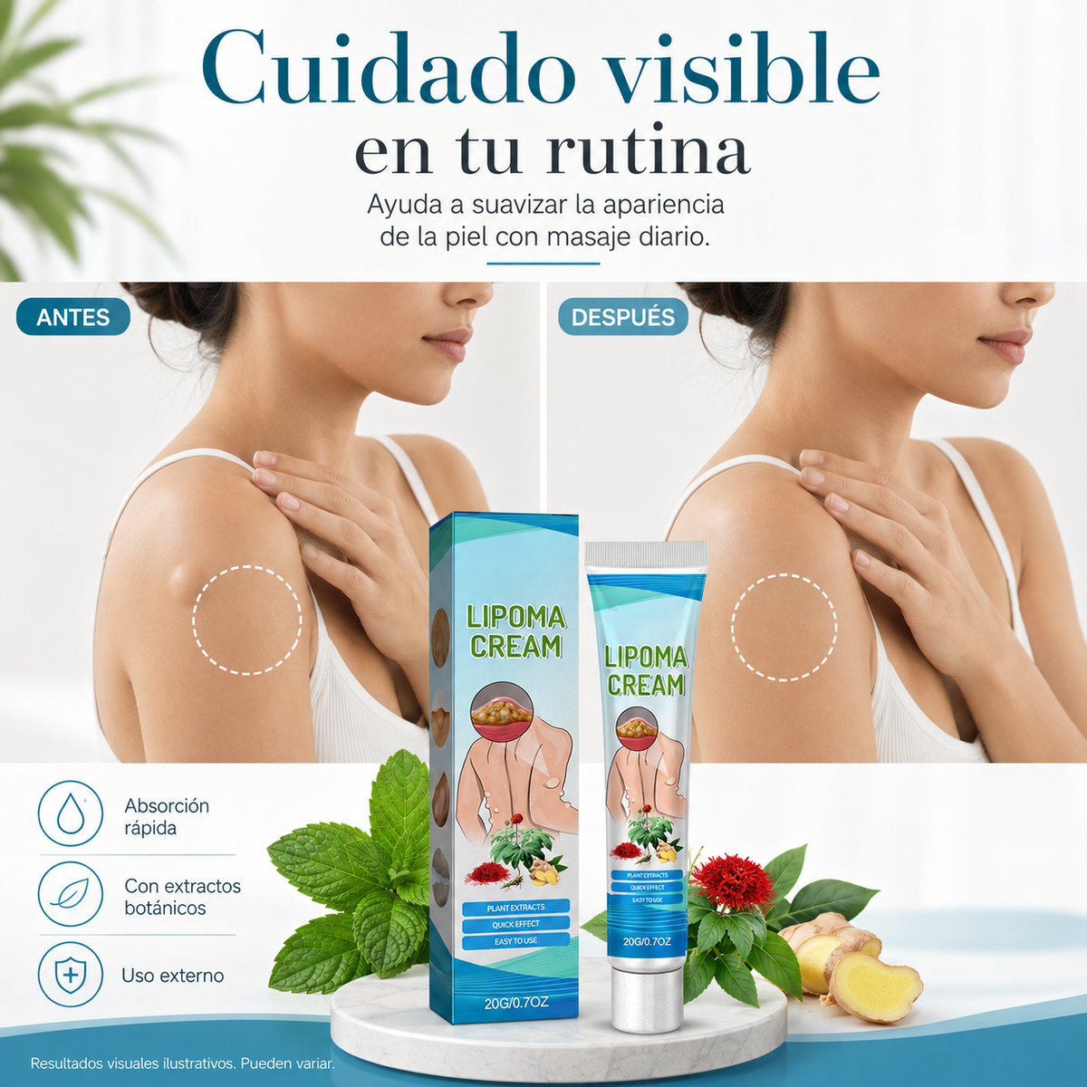 Crema para reducir bultos de grasa (lipomas)